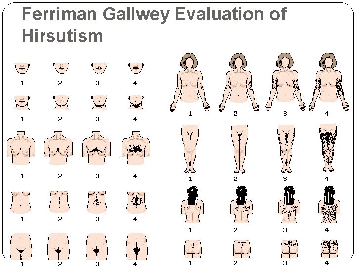 Ferriman Gallwey Evaluation of Hirsutism Ferriman Gallwey Evaluation of Hirsutism