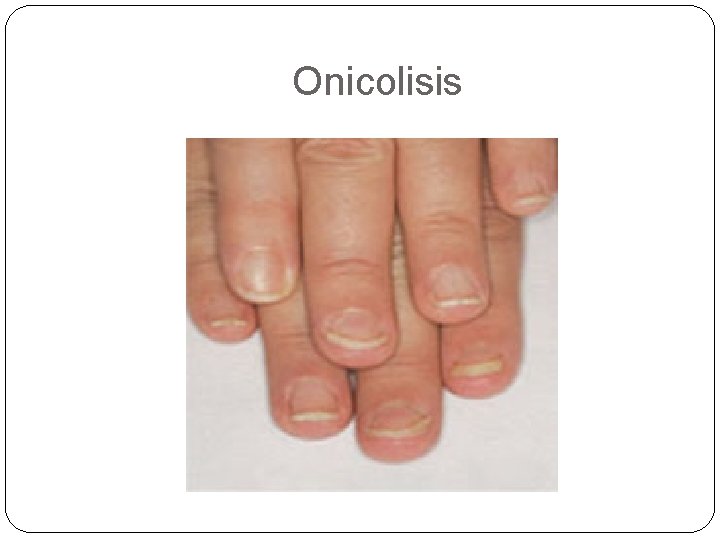 Onicolisis Onicolisis
