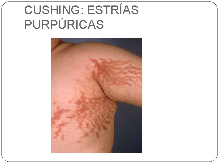 CUSHING: ESTRÍAS PURPÚRICAS CUSHING: ESTRÍAS PURPÚRICAS