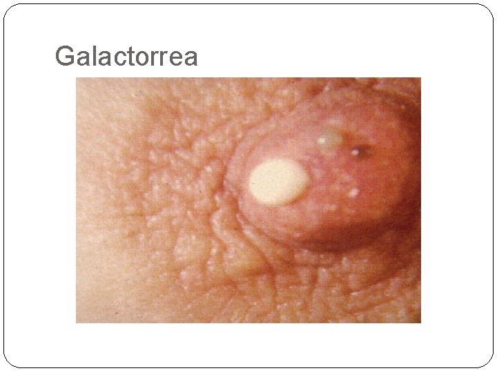 Galactorrea Galactorrea