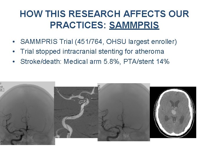 HOW THIS RESEARCH AFFECTS OUR PRACTICES: SAMMPRIS • SAMMPRIS Trial (451/764, OHSU largest enroller) HOW THIS RESEARCH AFFECTS OUR PRACTICES: SAMMPRIS • SAMMPRIS Trial (451/764, OHSU largest enroller)