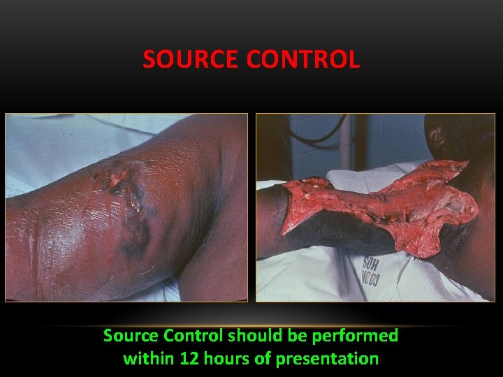 SOURCE CONTROL Source Control should be performed within 12 hours of presentation 