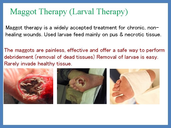 Maggot Therapy (Larval Therapy) Maggot therapy is a widely accepted treatment for chronic, nonhealing