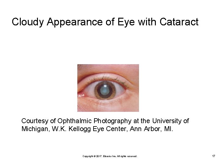 Cloudy Appearance of Eye with Cataract Courtesy of Ophthalmic Photography at the University of