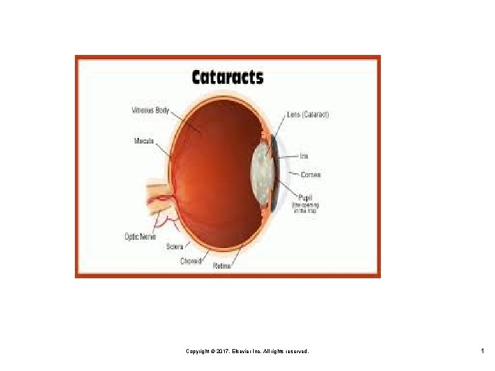 Copyright © 2017, Elsevier Inc. All rights reserved. 1 