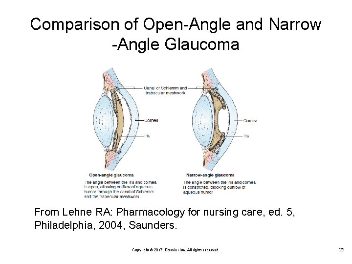 Comparison of Open-Angle and Narrow -Angle Glaucoma From Lehne RA: Pharmacology for nursing care,
