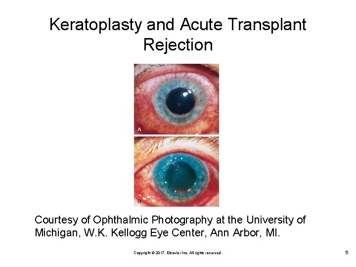 Keratoplasty and Acute Transplant Rejection Courtesy of Ophthalmic Photography at the University of Michigan,