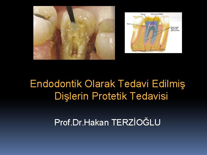 Endodontik Olarak Tedavi Edilmiş Dişlerin Protetik Tedavisi Prof. Dr. Hakan TERZİOĞLU 