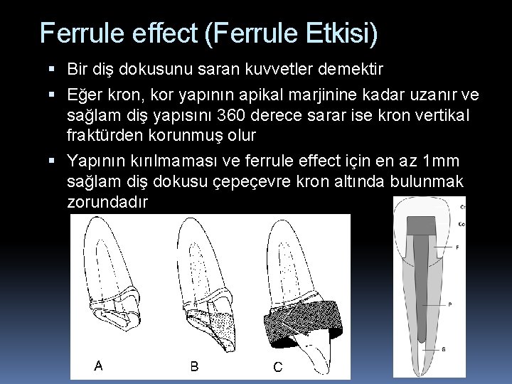 Ferrule effect (Ferrule Etkisi) Bir diş dokusunu saran kuvvetler demektir Eğer kron, kor yapının