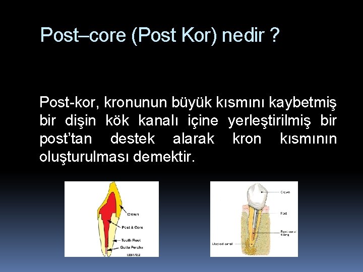 Post–core (Post Kor) nedir ? Post-kor, kronunun büyük kısmını kaybetmiş bir dişin kök kanalı