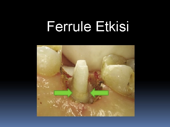 Ferrule Etkisi 