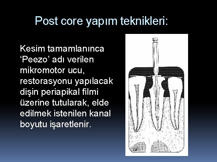 Post core yapım teknikleri: Kesim tamamlanınca ‘Peezo’ adı verilen mikromotor ucu, restorasyonu yapılacak dişin