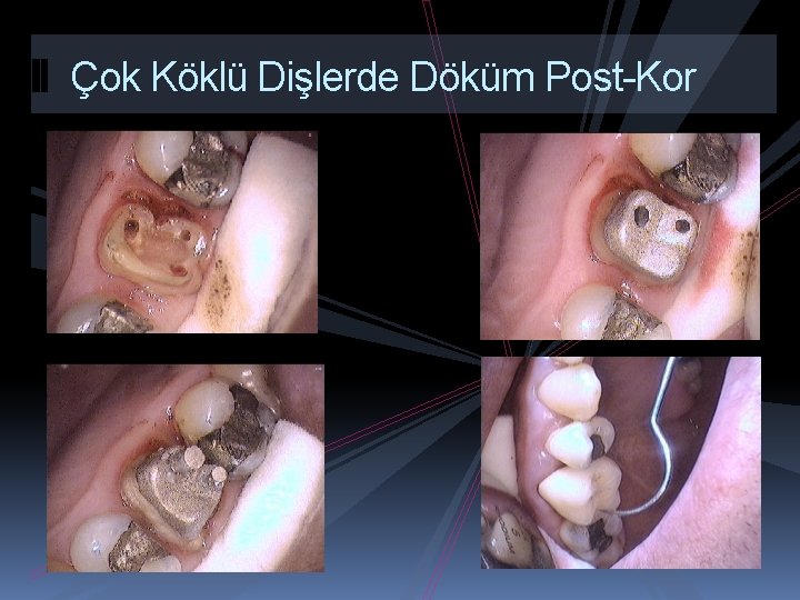 Çok Köklü Dişlerde Döküm Post-Kor 