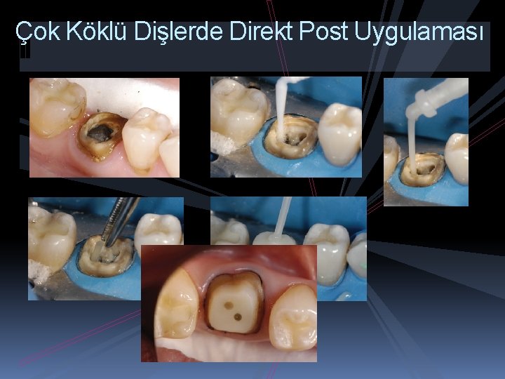 Çok Köklü Dişlerde Direkt Post Uygulaması 