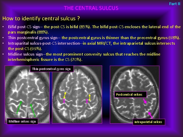 Part II THE CENTRAL SULCUS How to identify central sulcus ? • Bifid post-CS