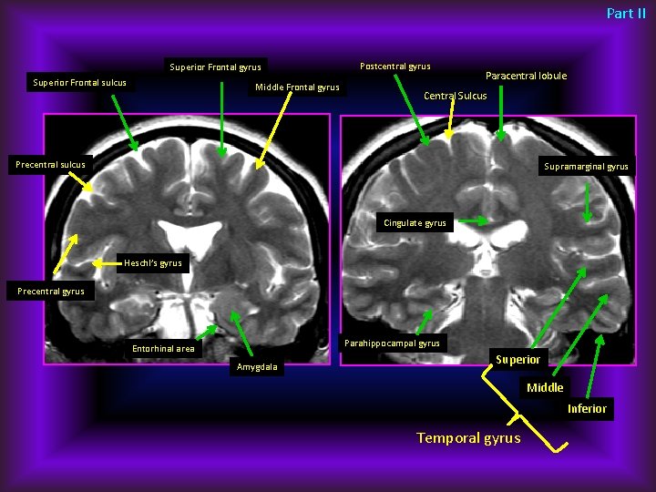 Part II Superior Frontal gyrus Superior Frontal sulcus Middle Frontal gyrus Postcentral gyrus Paracentral