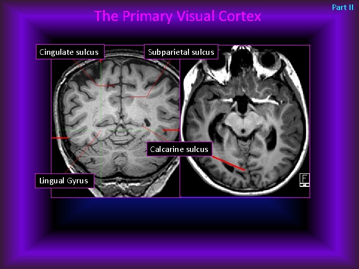 The Primary Visual Cortex Cingulate sulcus Subparietal sulcus Calcarine sulcus Lingual Gyrus Part II