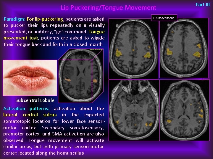 Lip Puckering/Tongue Movement Paradigm: For lip-puckering, patients are asked to pucker their lips repeatedly