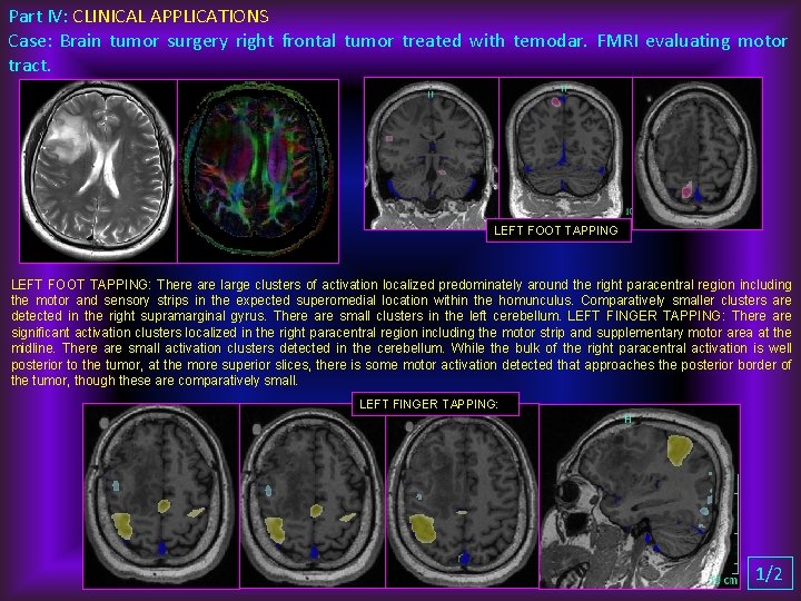 Part IV: CLINICAL APPLICATIONS Case: Brain tumor surgery right frontal tumor treated with temodar.