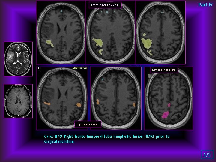 Part IV Left finger tapping Left foot tapping Lip movement Case: H/O Right fronto-temporal