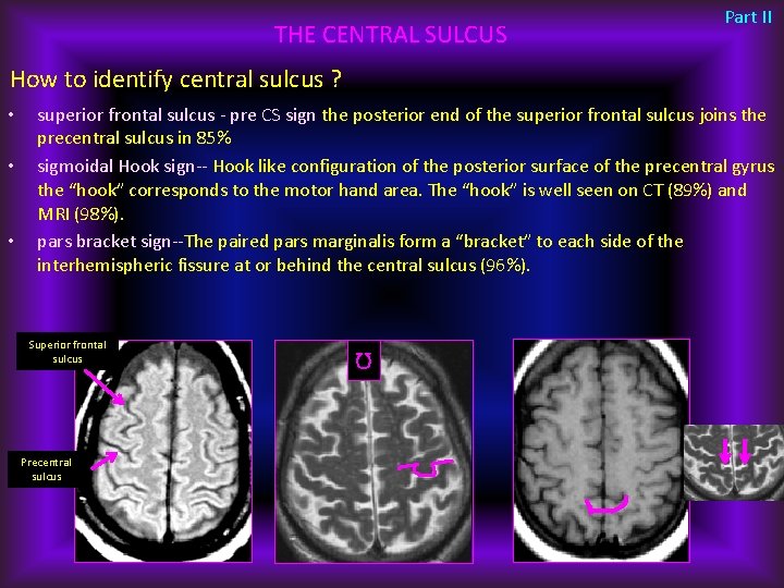 THE CENTRAL SULCUS Part II How to identify central sulcus ? • • •