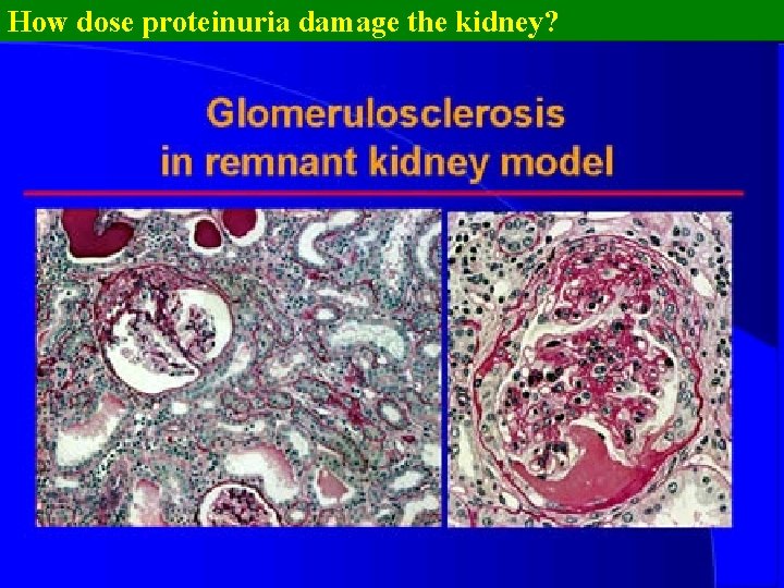 How dose proteinuria damage the kidney? 