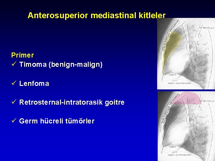 Anterosuperior mediastinal kitleler Primer ü Timoma (benign-malign) ü Lenfoma ü Retrosternal-intratorasik goitre ü Germ