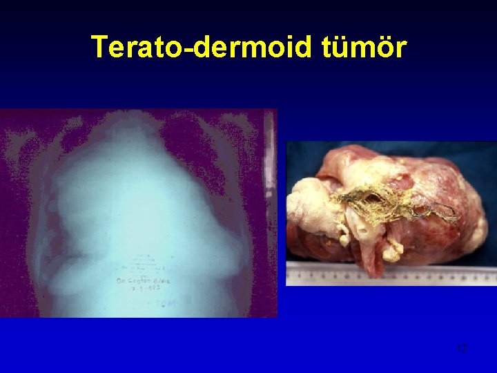 Terato-dermoid tümör 12 