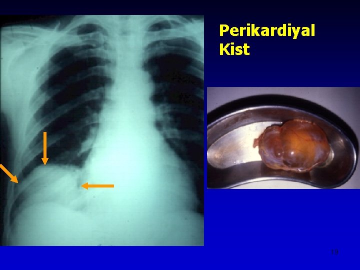 Perikardiyal Kist 19 