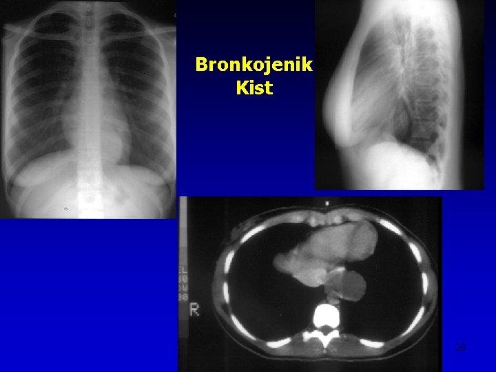 Bronkojenik Kist 20 