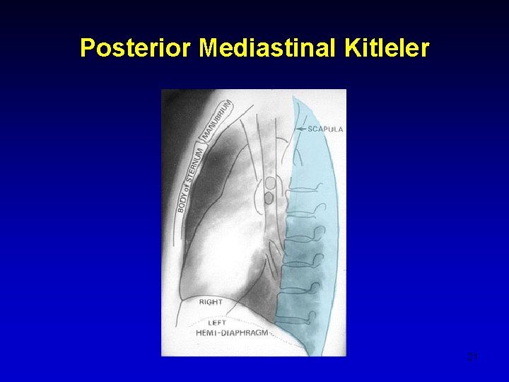 Posterior Mediastinal Kitleler 21 