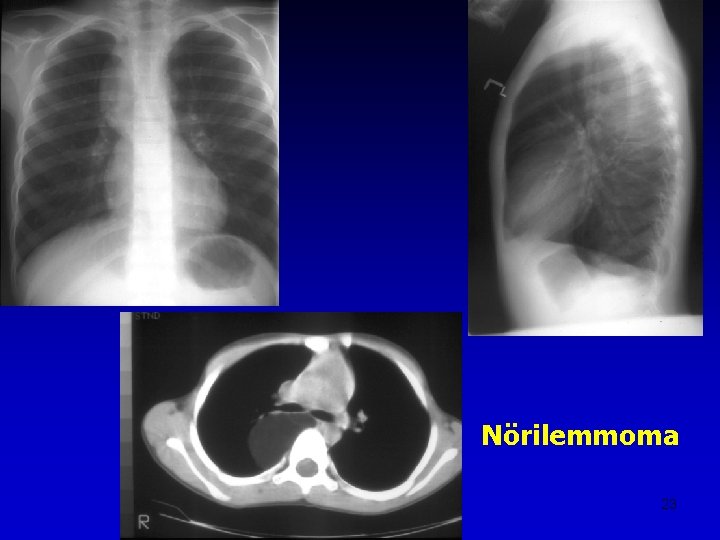 Nörilemmoma 23 