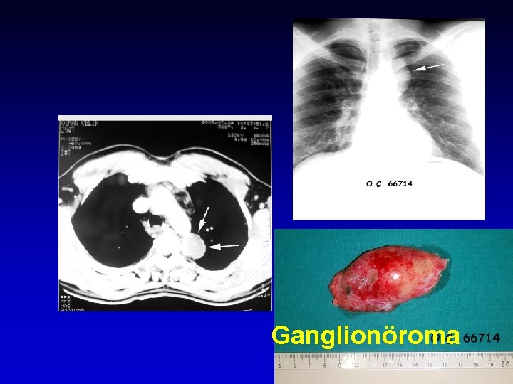 Ganglionöroma 24 