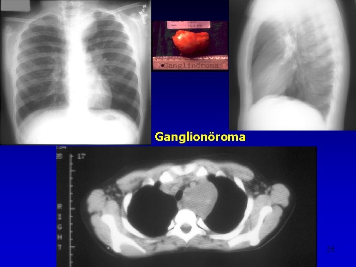 Ganglionöroma 25 