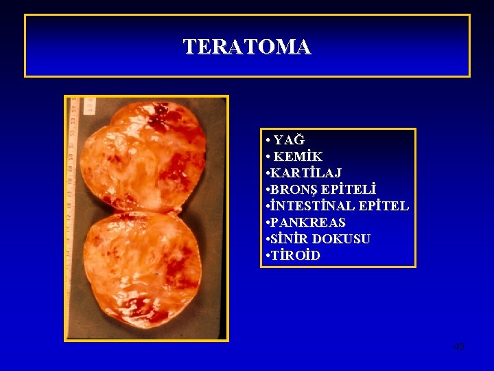 TERATOMA • YAĞ • KEMİK • KARTİLAJ • BRONŞ EPİTELİ • İNTESTİNAL EPİTEL •