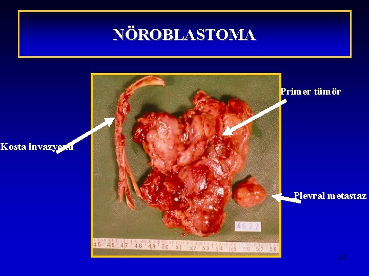 NÖROBLASTOMA Primer tümör Kosta invazyonu Plevral metastaz 47 
