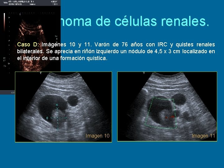 3. Carcinoma de células renales. Caso D: Imágenes 10 y 11. Varón de 76