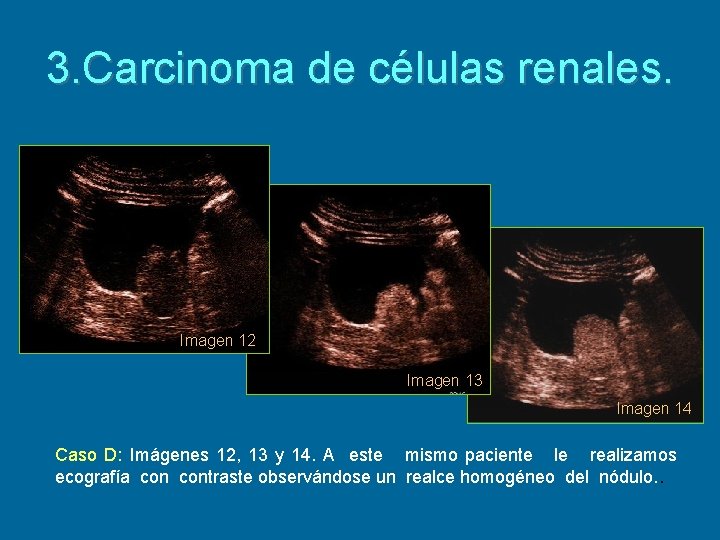 3. Carcinoma de células renales. Imagen 12 Imagen 13 Imagen 14 Caso D: Imágenes