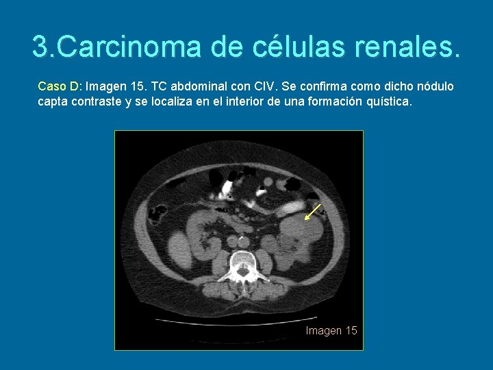 3. Carcinoma de células renales. Caso D: Imagen 15. TC abdominal con CIV. Se