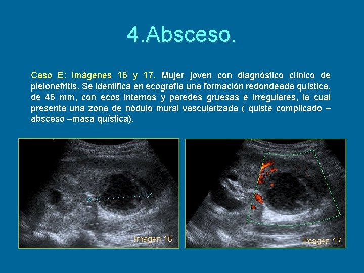 4. Absceso. Caso E: Imágenes 16 y 17. Mujer joven con diagnóstico clínico de