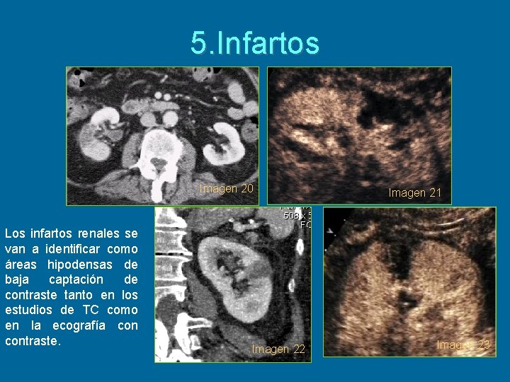 5. Infartos Imagen 20 Los infartos renales se van a identificar como áreas hipodensas