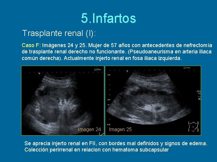 5. Infartos Trasplante renal (I): Caso F: Imágenes 24 y 25. Mujer de 57