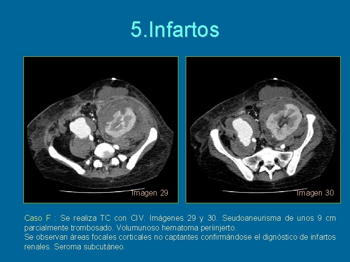 5. Infartos Imagen 29 Imagen 30 Caso F : Se realiza TC con CIV.