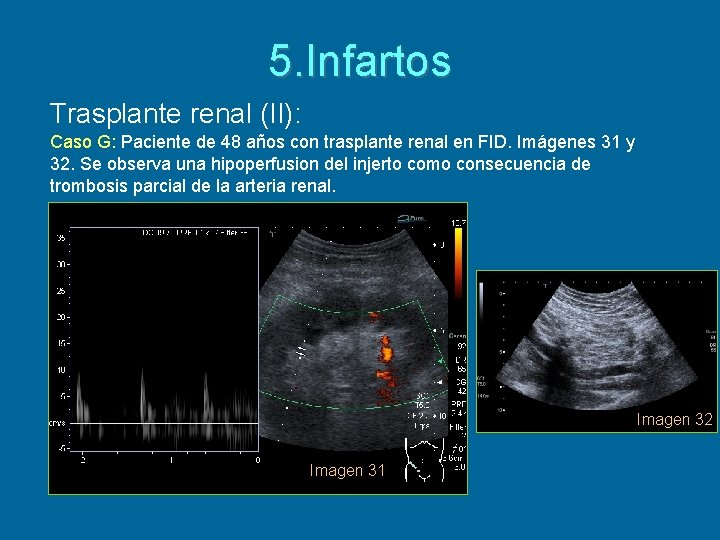 5. Infartos Trasplante renal (II): Caso G: Paciente de 48 años con trasplante renal