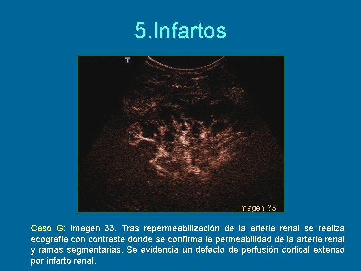 5. Infartos Imagen 33 Caso G: Imagen 33. Tras repermeabilización de la arteria renal