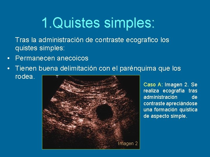 1. Quistes simples: Tras la administración de contraste ecografico los quistes simples: • Permanecen