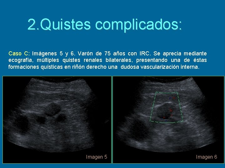 2. Quistes complicados: Caso C: Imágenes 5 y 6. Varón de 75 años con