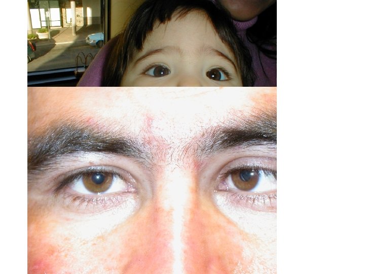 Strabismus And Eye Muscle Surgery G Vike Vicente