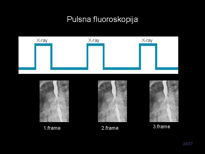 Pulsna fluoroskopija X-ray 1. frame X-ray 2. frame 3. frame 24/37 
