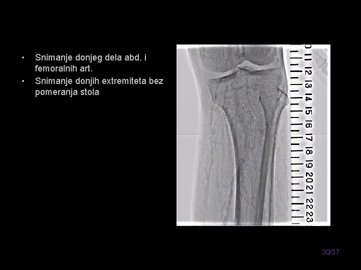  • • Snimanje donjeg dela abd. i femoralnih art. Snimanje donjih extremiteta bez